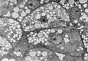 F,1y. | steatosis - Reye hepatocerebral syndrome